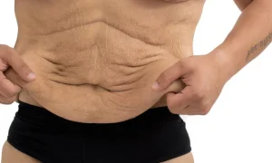 ترهل الجلد بعد خسارة الوزن